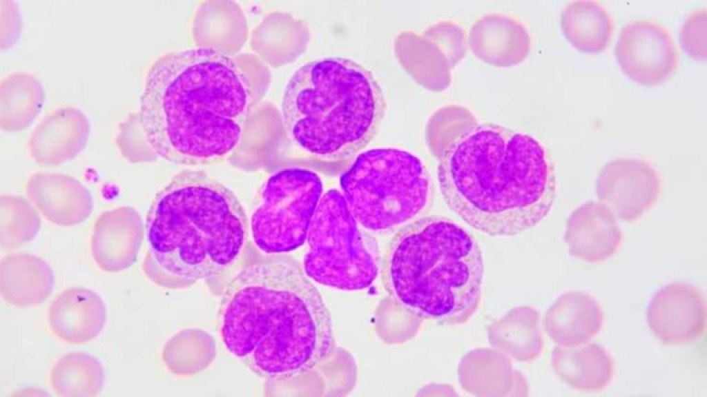 9 de cada 10 pacientes con leucemia linfocítica crónica no reconocen los síntomas antes del diagnóstico