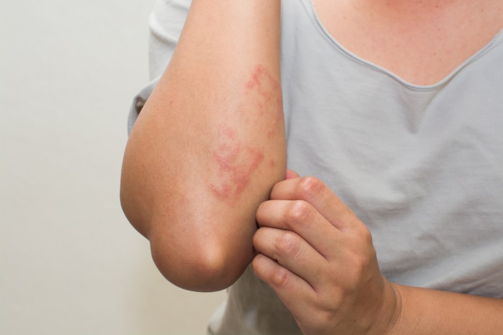 Dormir bien, un desafío cotidiano para quienes viven con dermatitis atópica