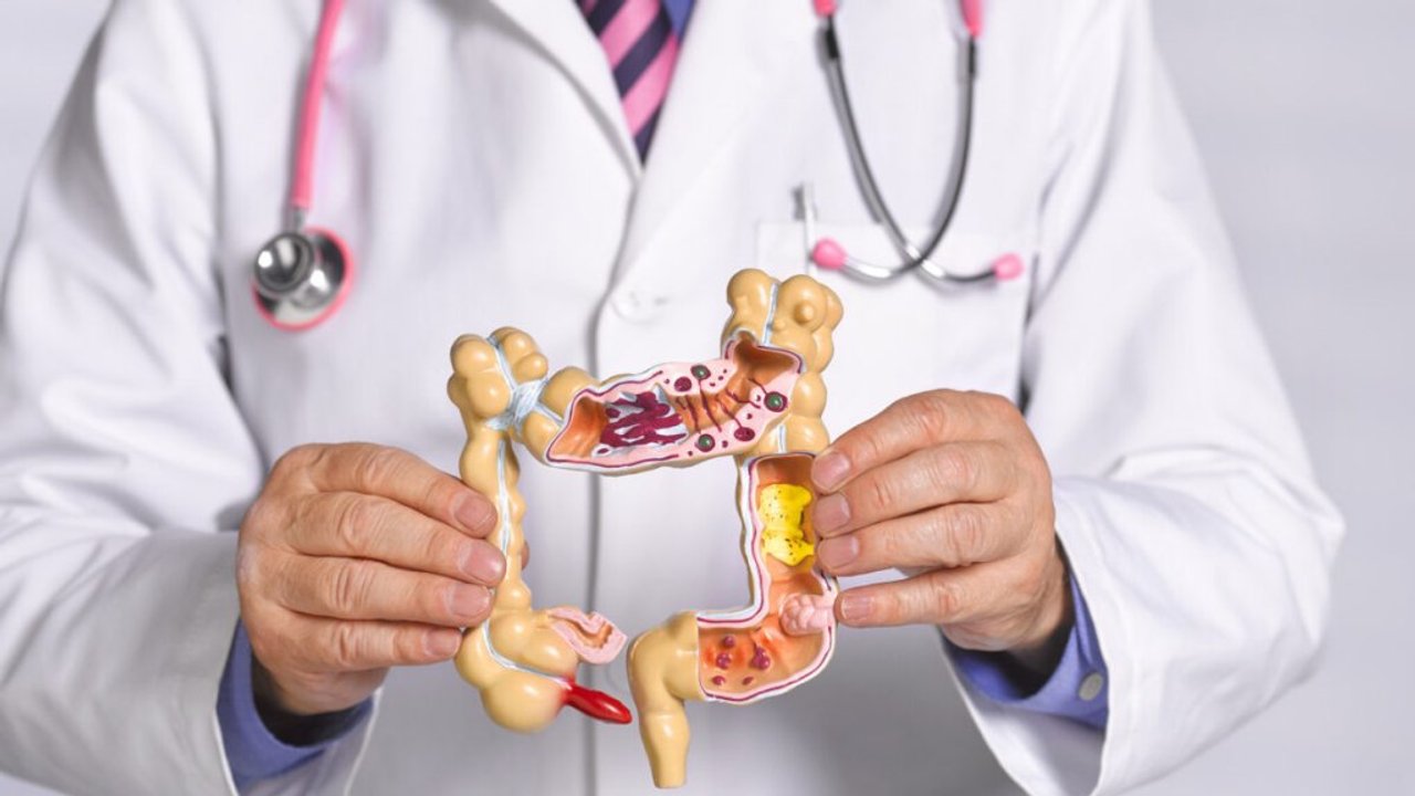 Nuevas terapias y medicina de precisión mejoran el pronóstico del cáncer de colon