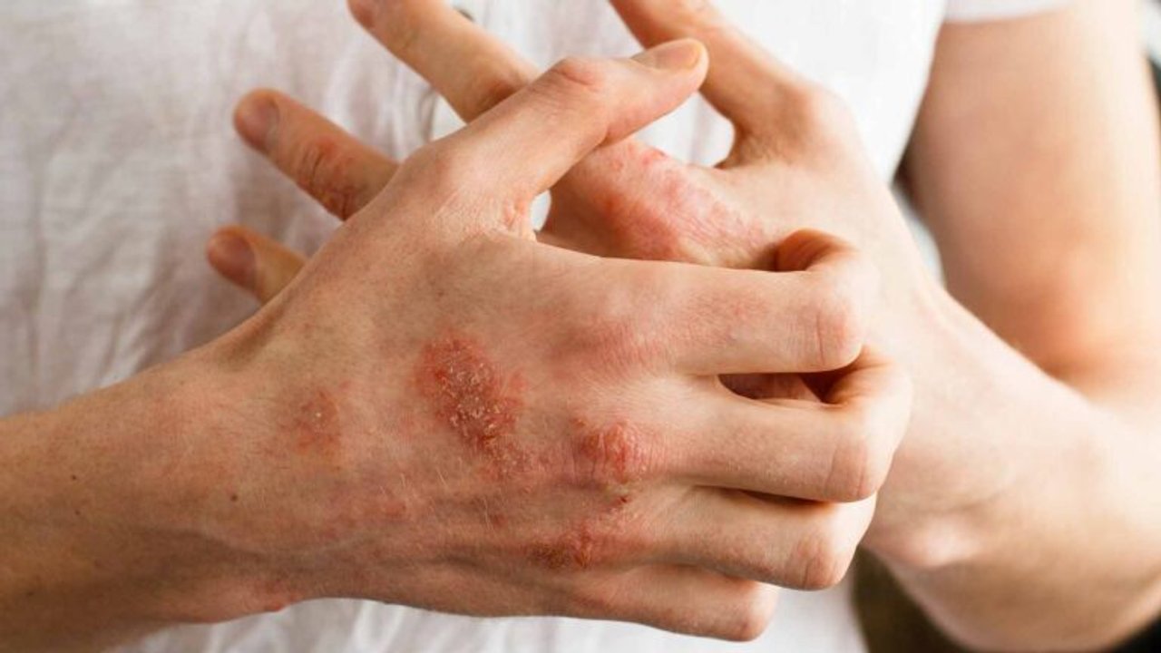 ANMAT aprueba en Argentina nueva terapia oral para artritis psoriásica en adultos