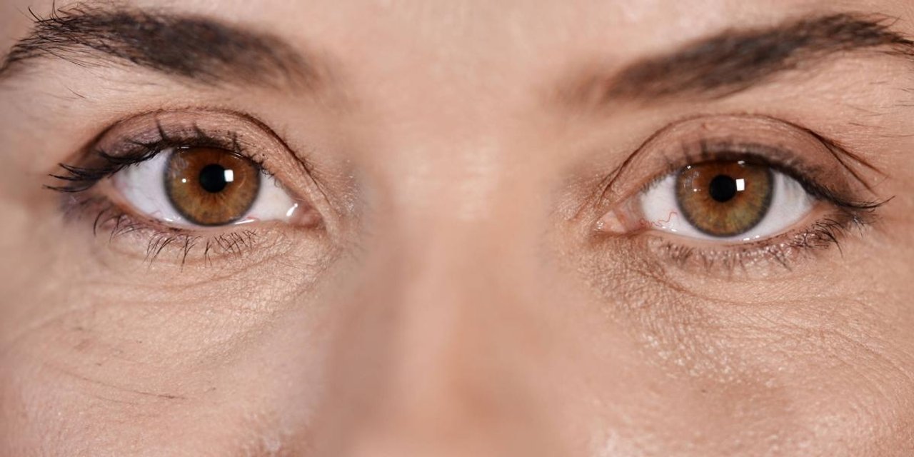 Párpados caídos y bolsas: cómo funciona la blefaroplastia con láser híbrido