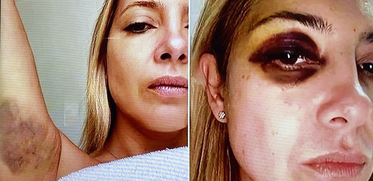 Fabiola Yañez ratificó que Alberto Fernández la golpeó: “Ese ojo morado existió”