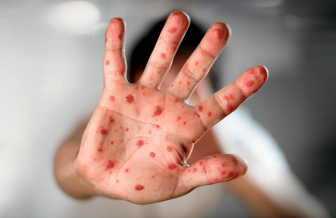 Profesionales de la salud analizan la evolución de los casos de Mpox en Argentina