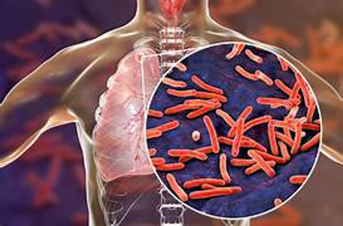 Tuberculosis: alerta por el aumento de casos en Argentina