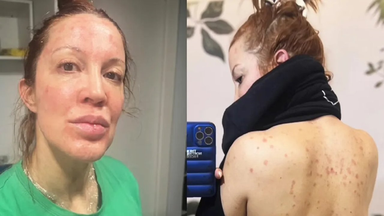 Miriam Lanzoni habló sobre el impacto de la psoriasis en su vida y su trabajo