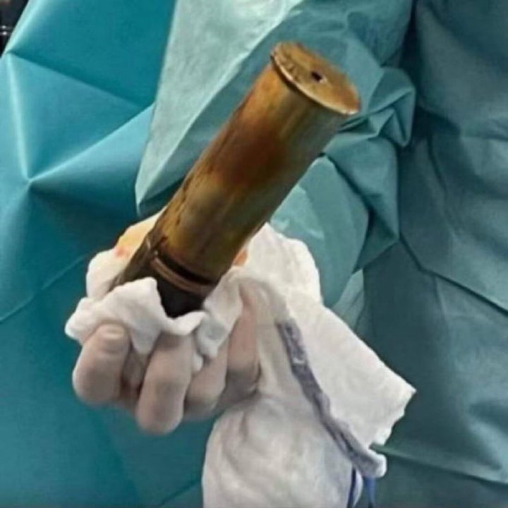Hospital evacuado en Toulouse por proyectil de la Primera Guerra Mundial