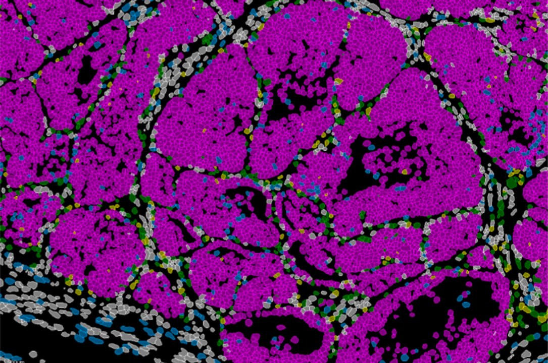 Hallan un gen que determina si las células de cáncer formarán metástasis o se quedarán dormidas