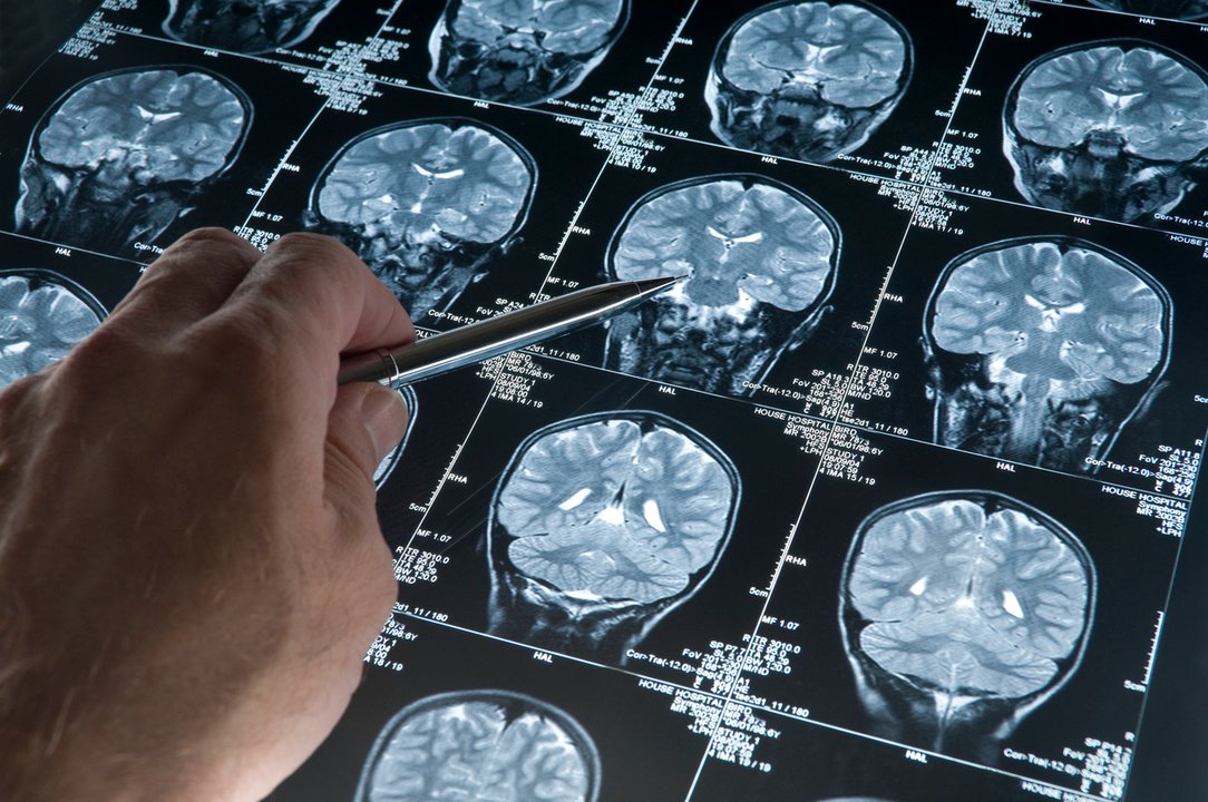 Con inteligencia artificial logran reducir un 90% el tiempo que lleva hacer una resonancia magnética