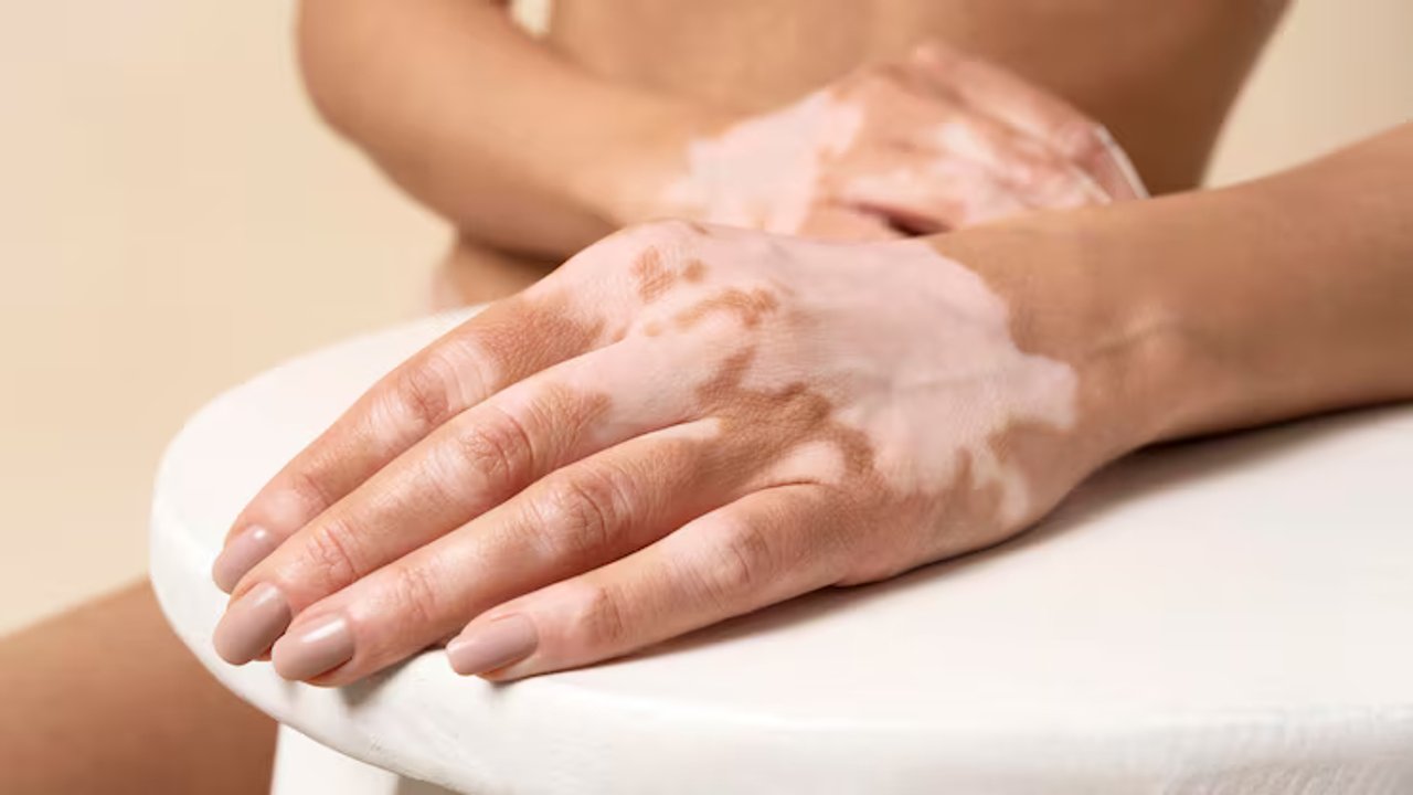 Día Mundial del Vitiligo: los mitos que los especialistas buscan derribar