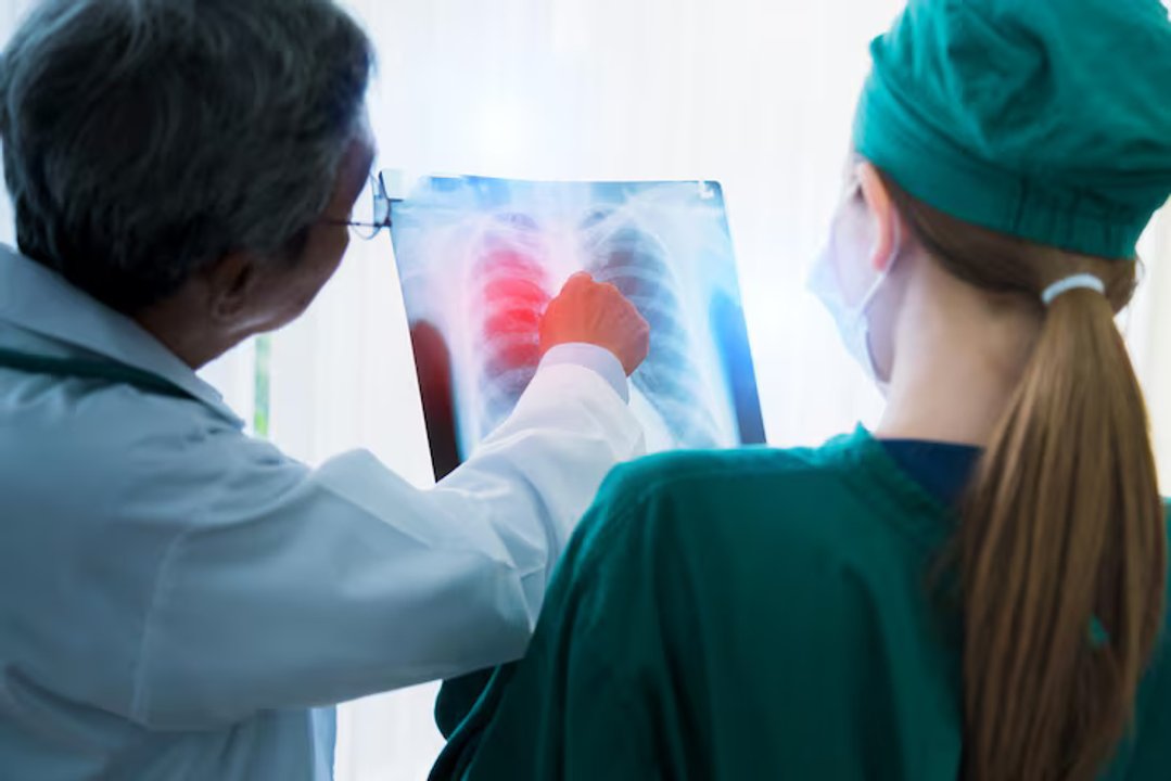 Falta de aire y tos persistente: ¿pueden ser señales de fibrosis pulmonar?