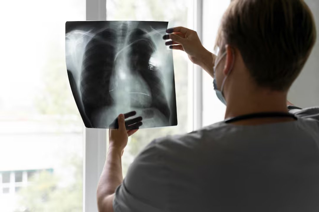 Derrame pleural: ¿qué es y cómo se detecta?