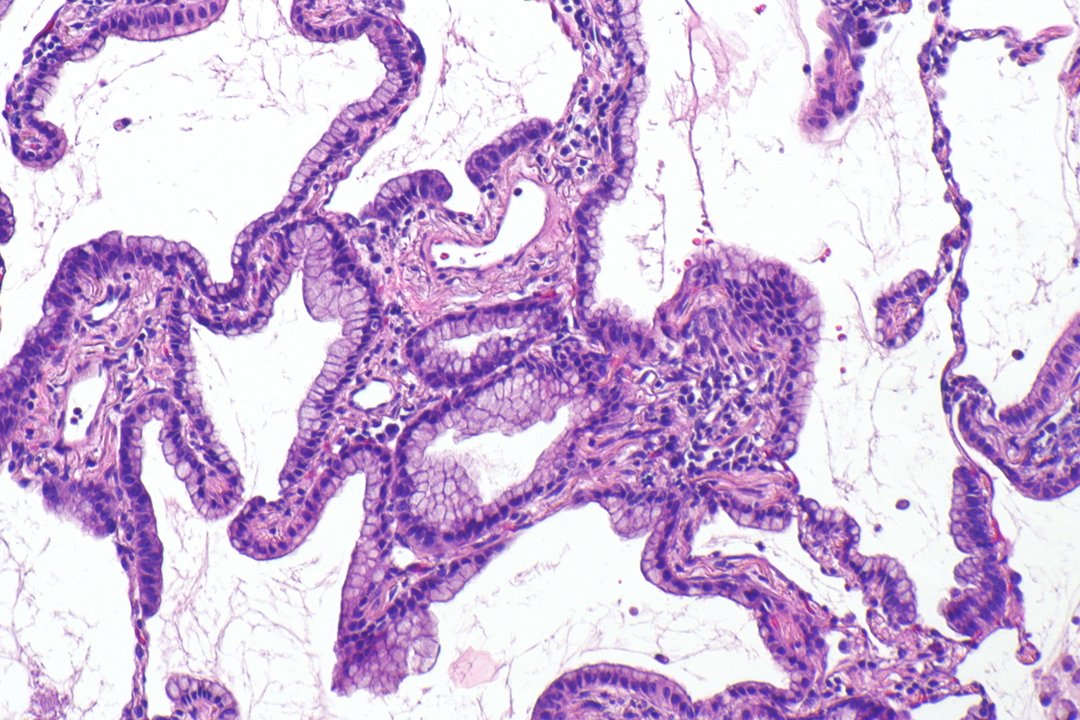 Qué es un adenocarcinoma pulmonar: síntomas, causas y tratamientos