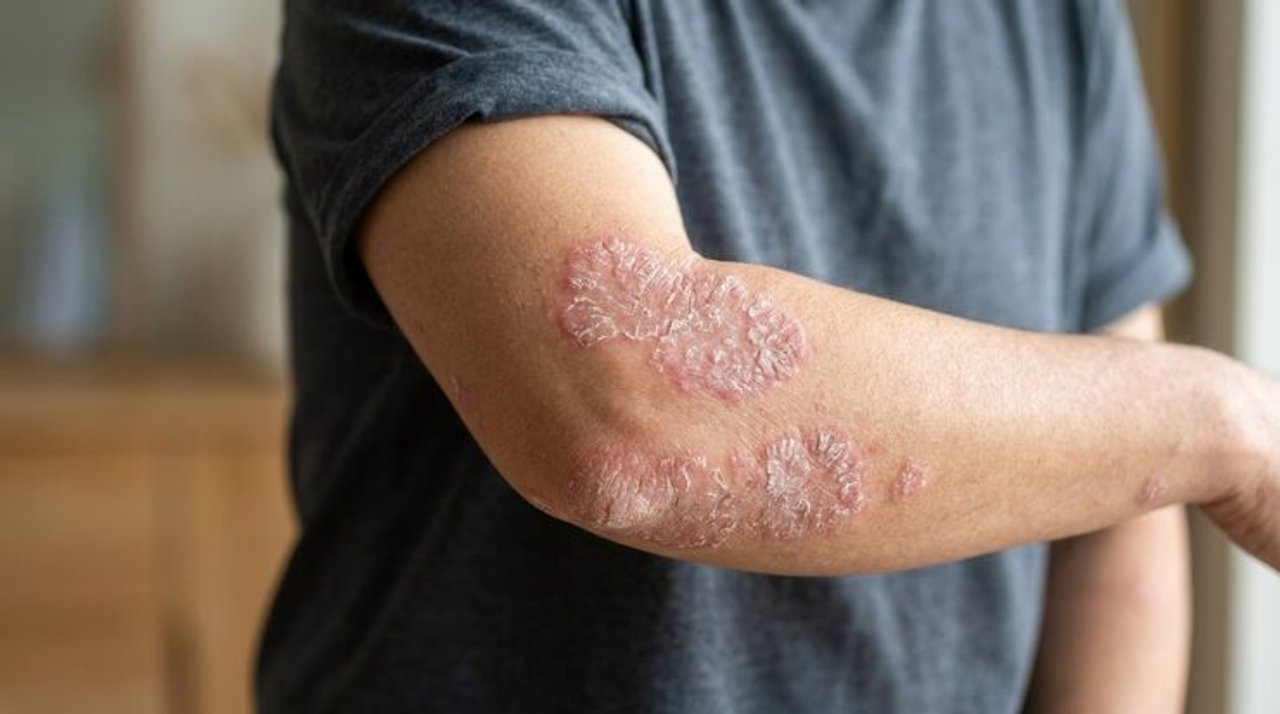Día Mundial de la Psoriasis: tener poca piel afectada no siempre significa una enfermedad leve